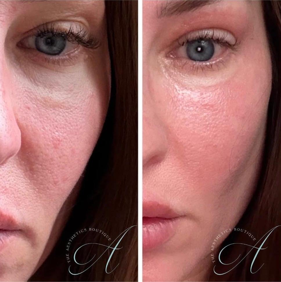 Plexr Upper Eyelid Lift Before and After - Binbrook, Ontario